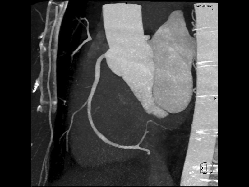 Cardiac CT